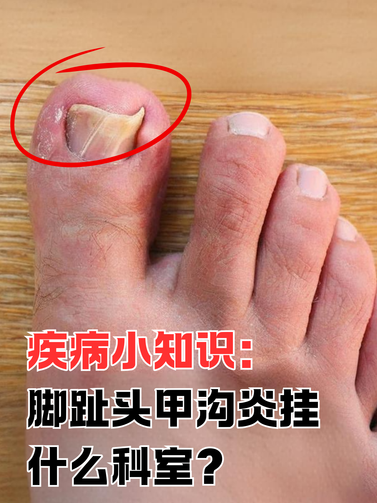 疾病小知识:脚趾头甲沟炎挂什么科室 在日常生活中,脚趾头甲沟炎是一