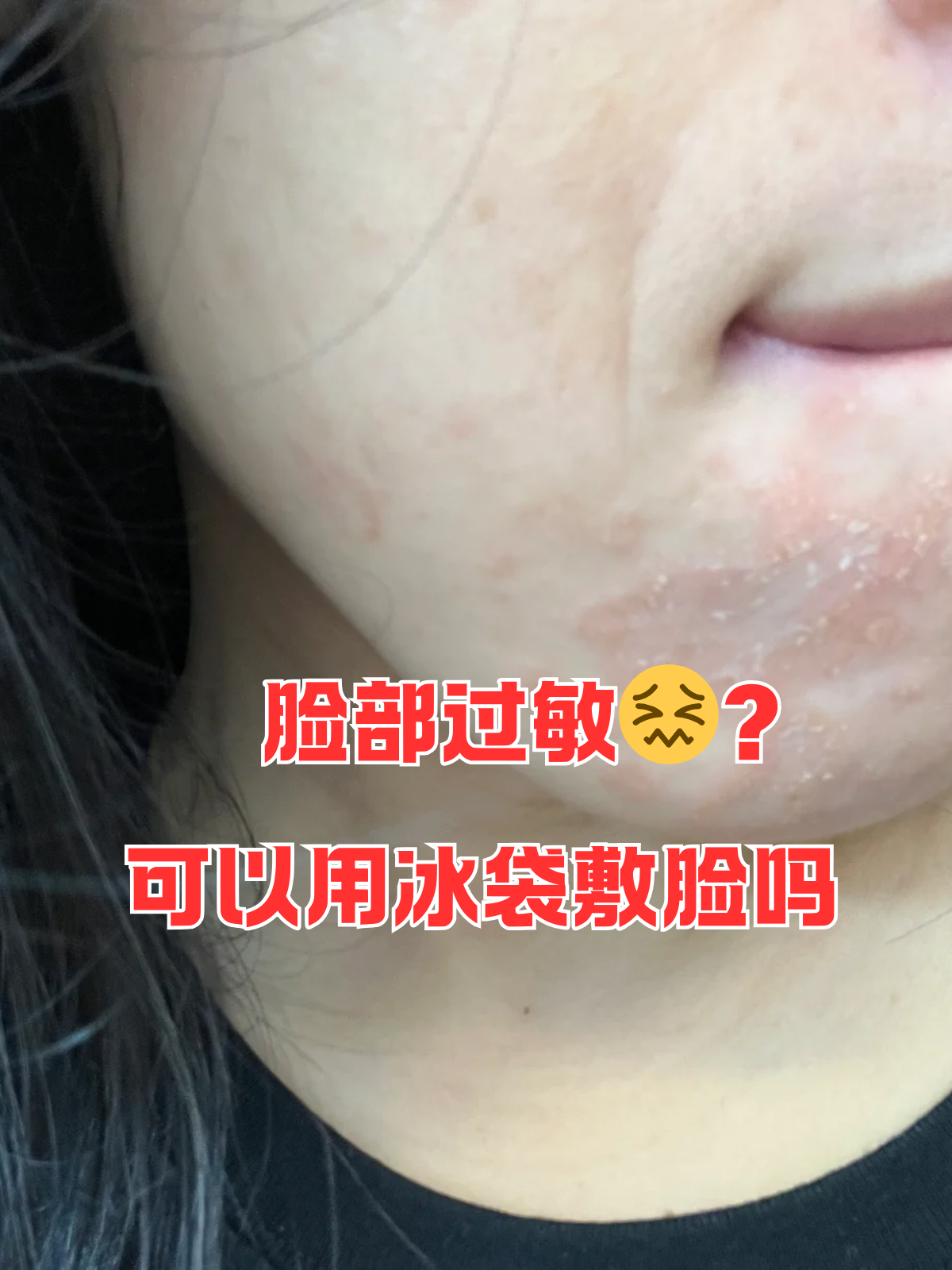 脸部过敏?