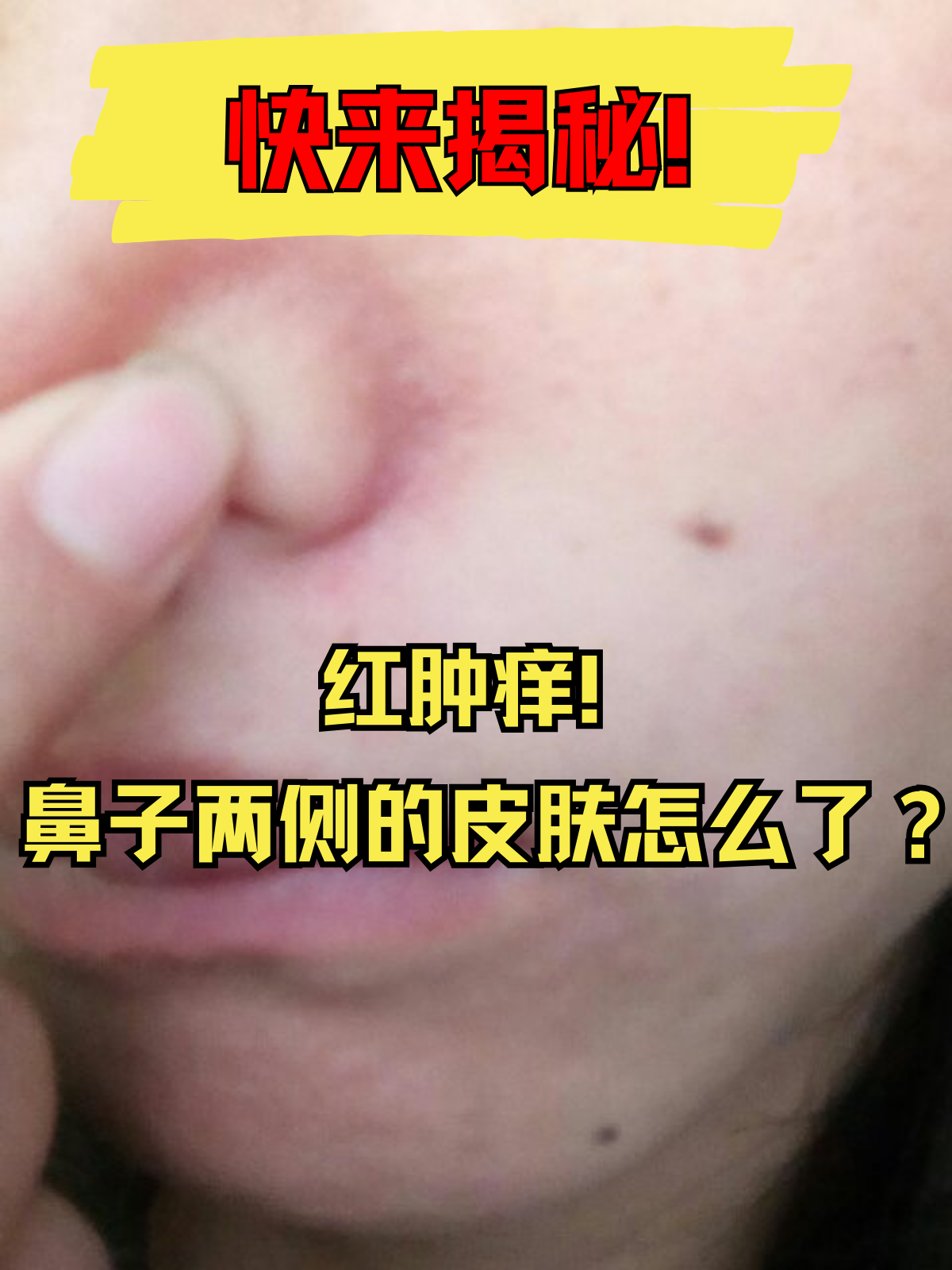 鼻子两侧的皮肤怎么了?快来揭秘!
