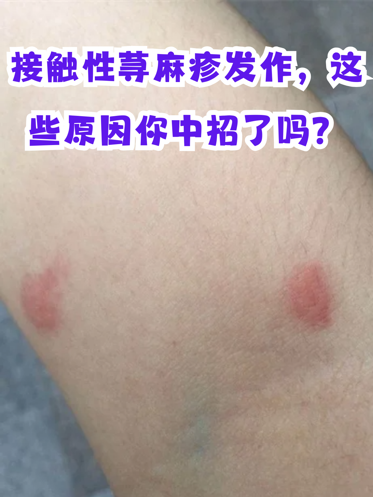 间歇性荨麻疹是什么症状(间歇性荨麻疹是什么症状表现)