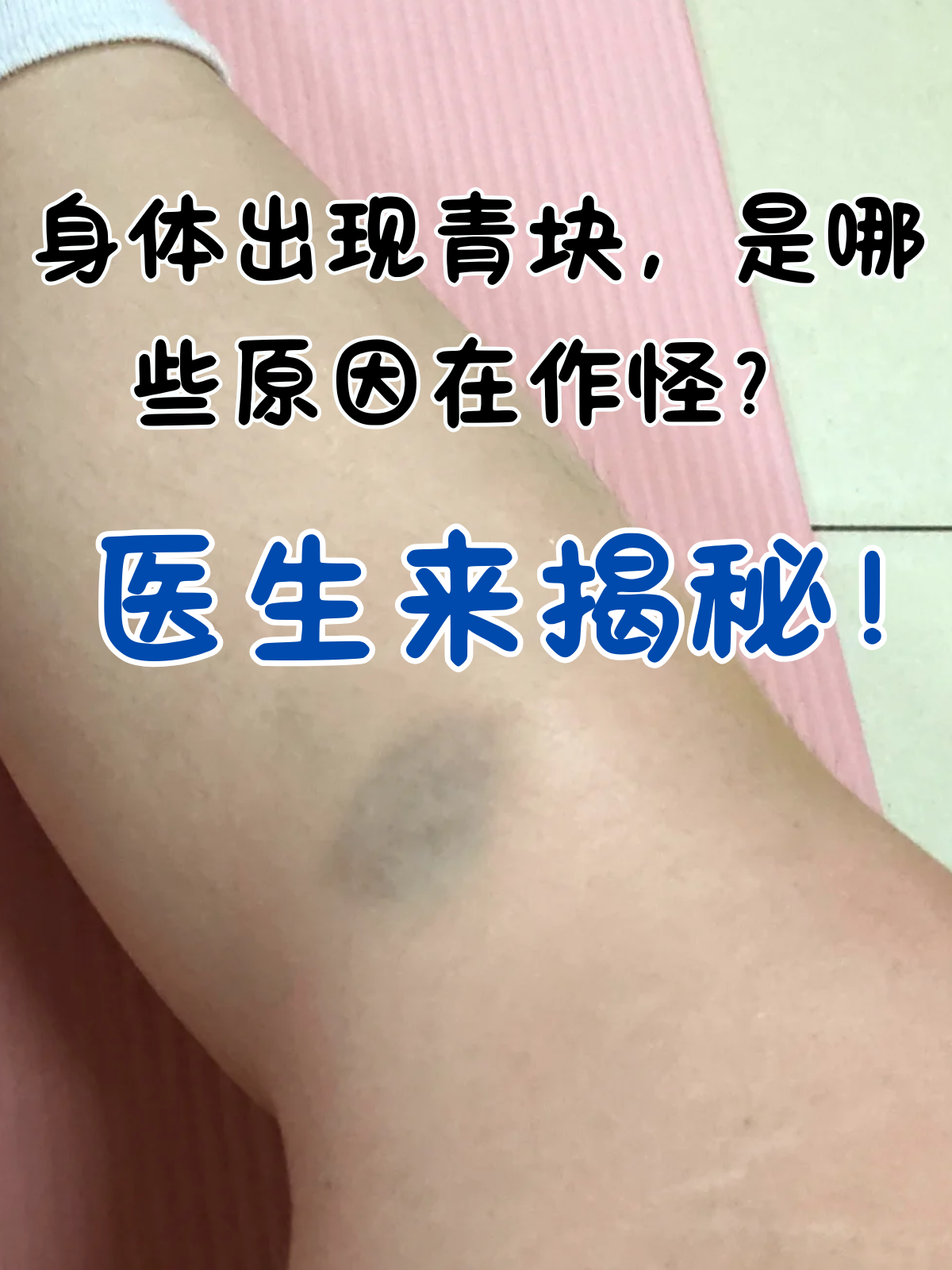 早期瘀斑图白血病皮肤瘀斑图片白血病小腿淤青图片儿童白血病淤青图片