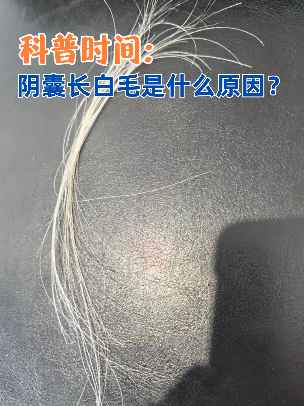 阴囊长白毛这个症状可能让许多人感到不安,这个症状可能是由多种因素