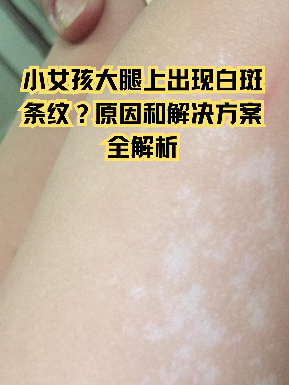 蒙古斑为什么叫蒙古斑