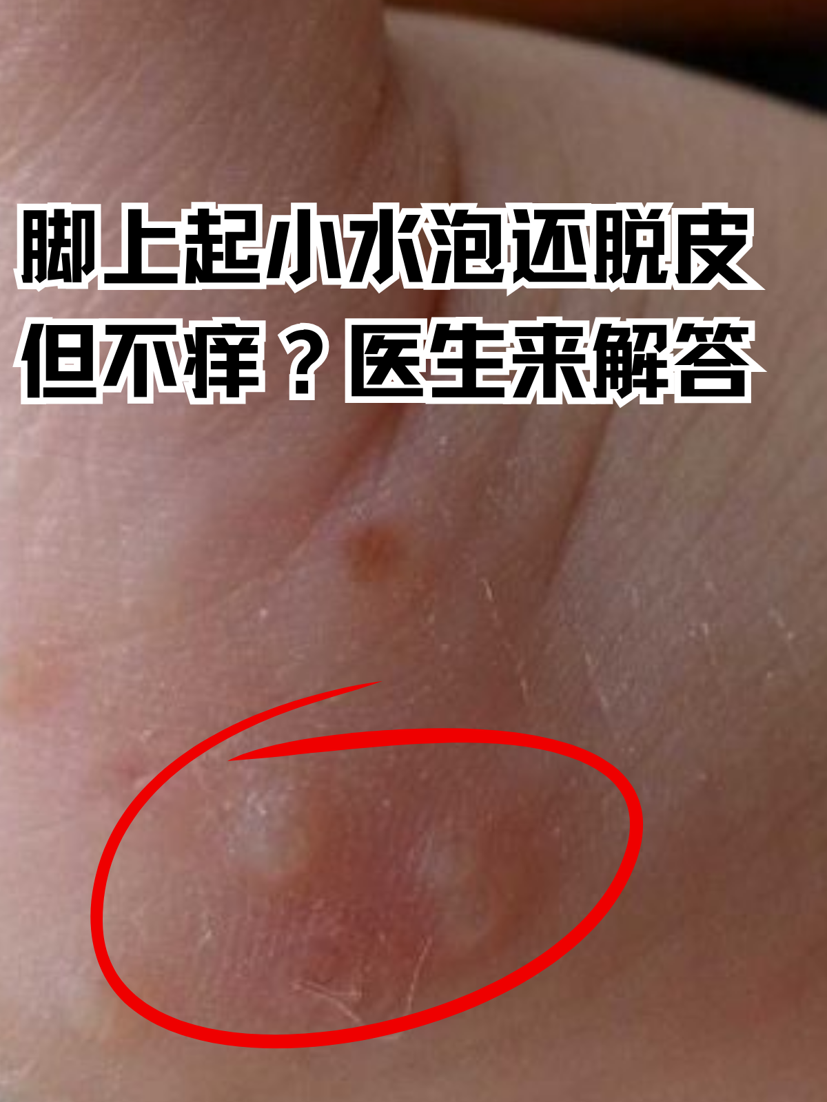 脚上起小水泡还脱皮但不痒?
