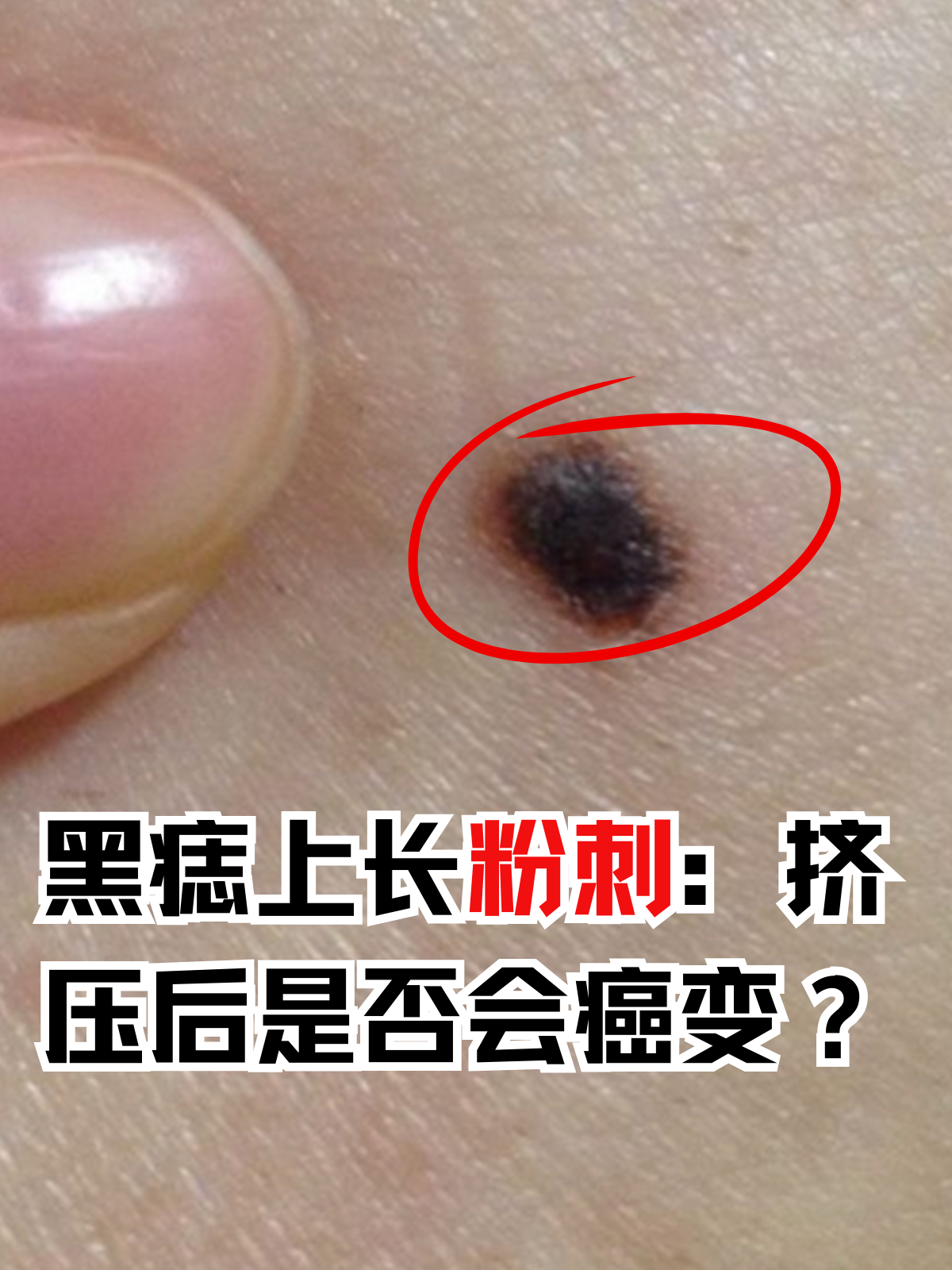 黑痣又名色素痣,是由痣细胞组成的色素性病变