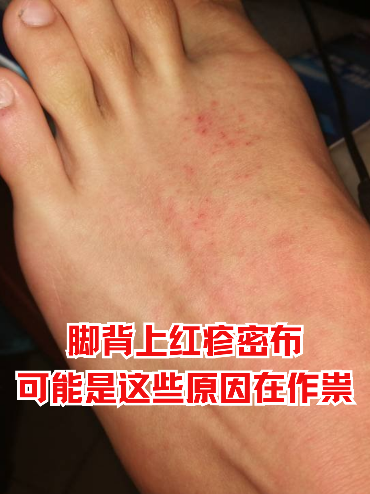 脚背上红疹密布,可能是这些原因在作祟 在日常生活中,不少人可能会