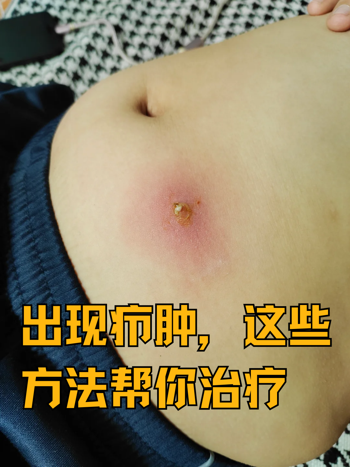 出现疖肿,这些方法帮你治疗 疖肿,这一常见的皮肤感