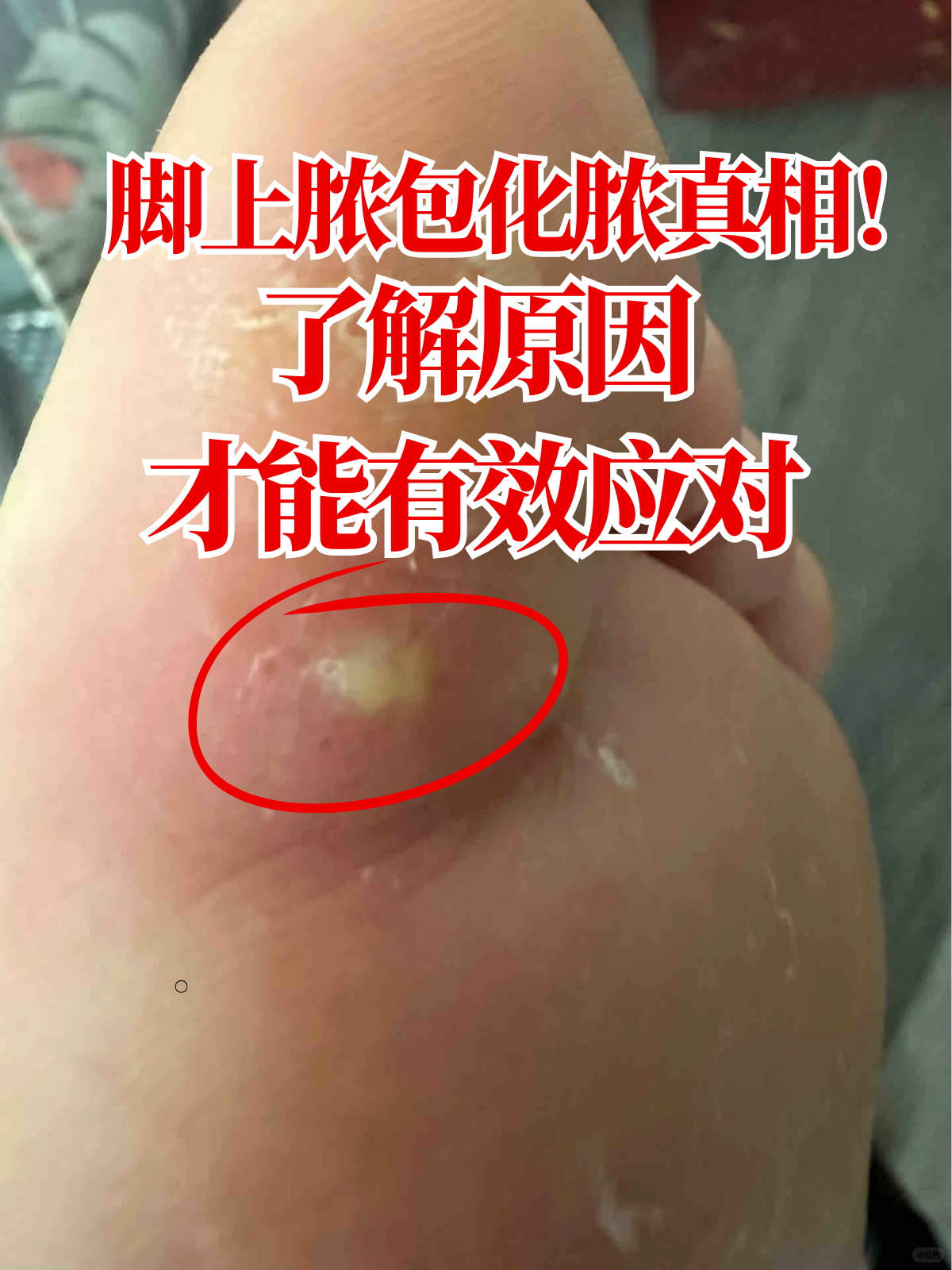 脚上脓包化脓真相!了解原因才能有效应对!