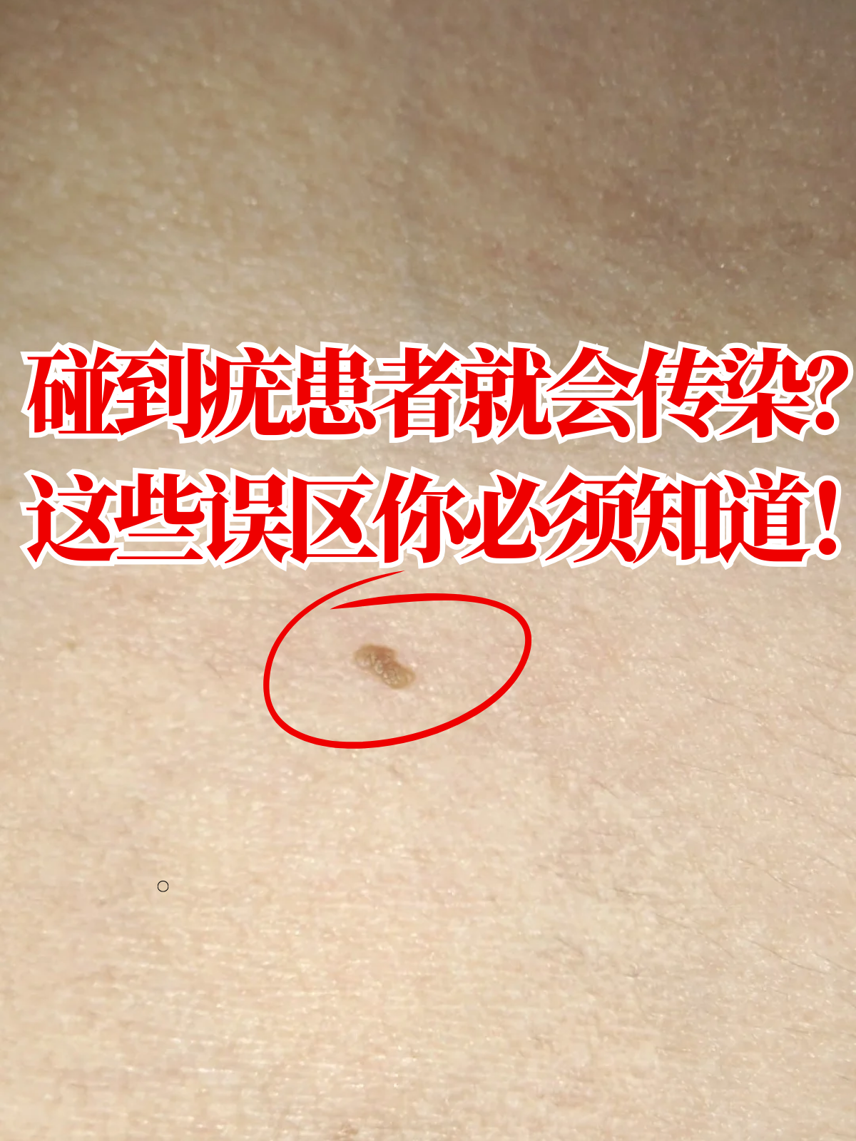 疣,医学上称为"疣状赘生物",是一种由人乳头瘤病毒