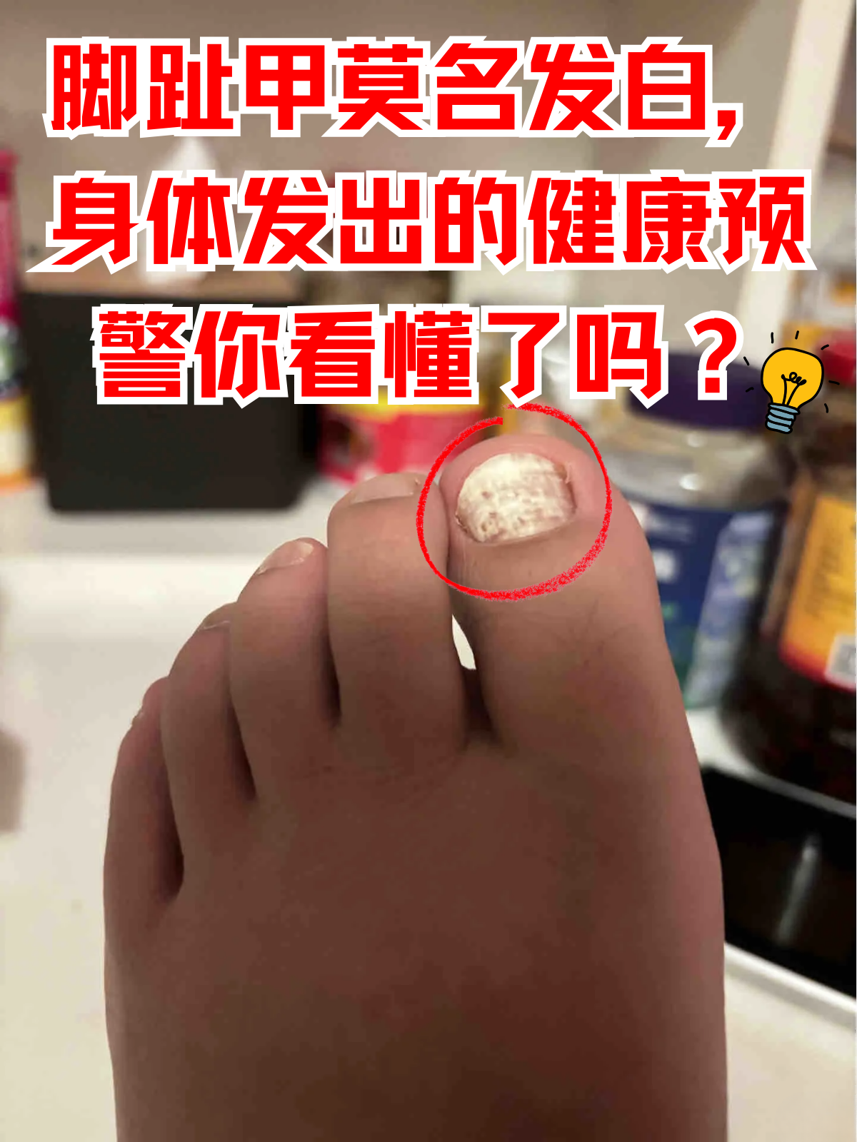 给大家详细剖析一下脚趾甲发白的常见原因
