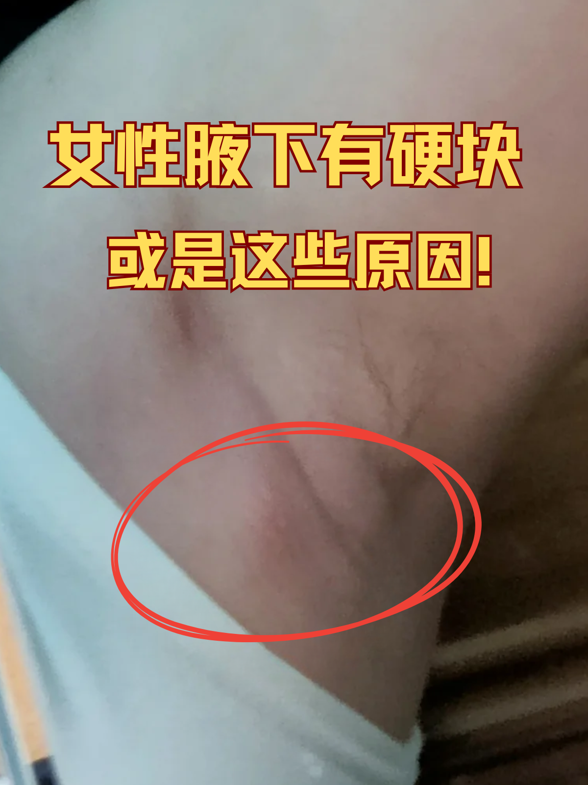 为什么有副乳胸还很大为什么在线