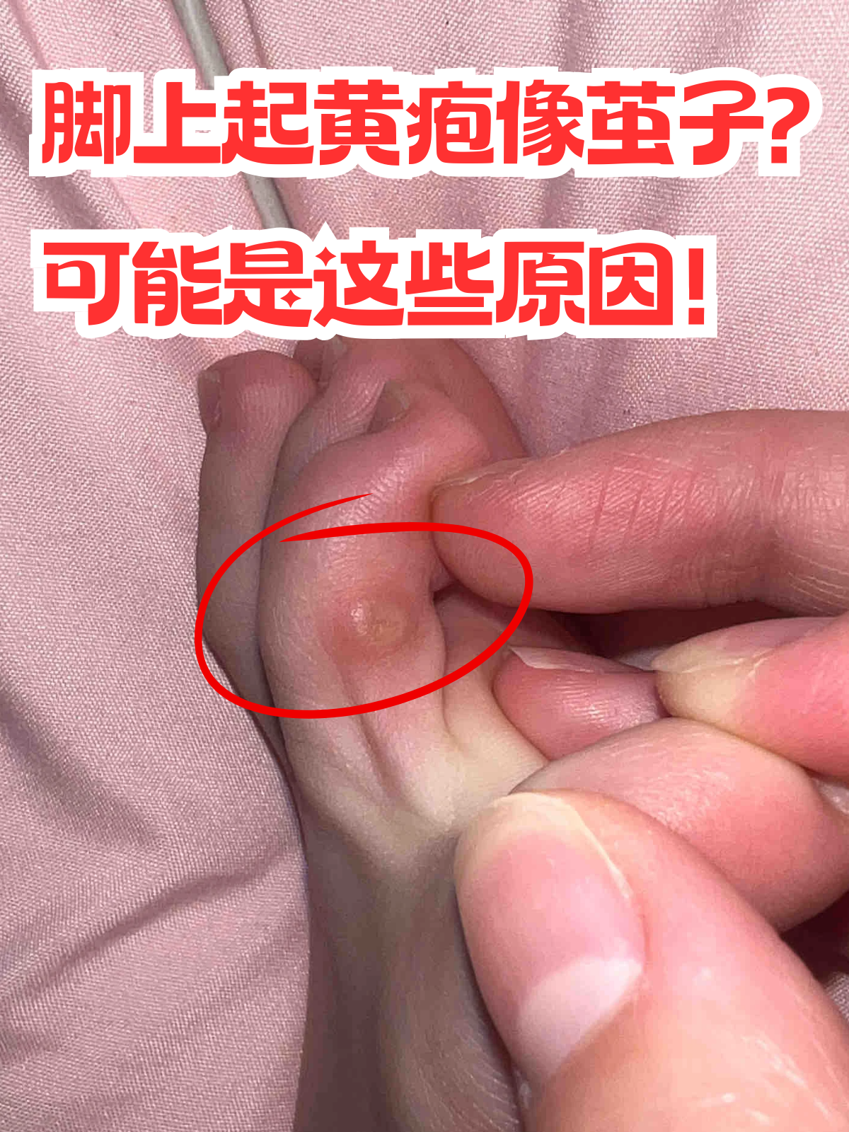 脚上起黄疱像茧子?可能是这些原因!