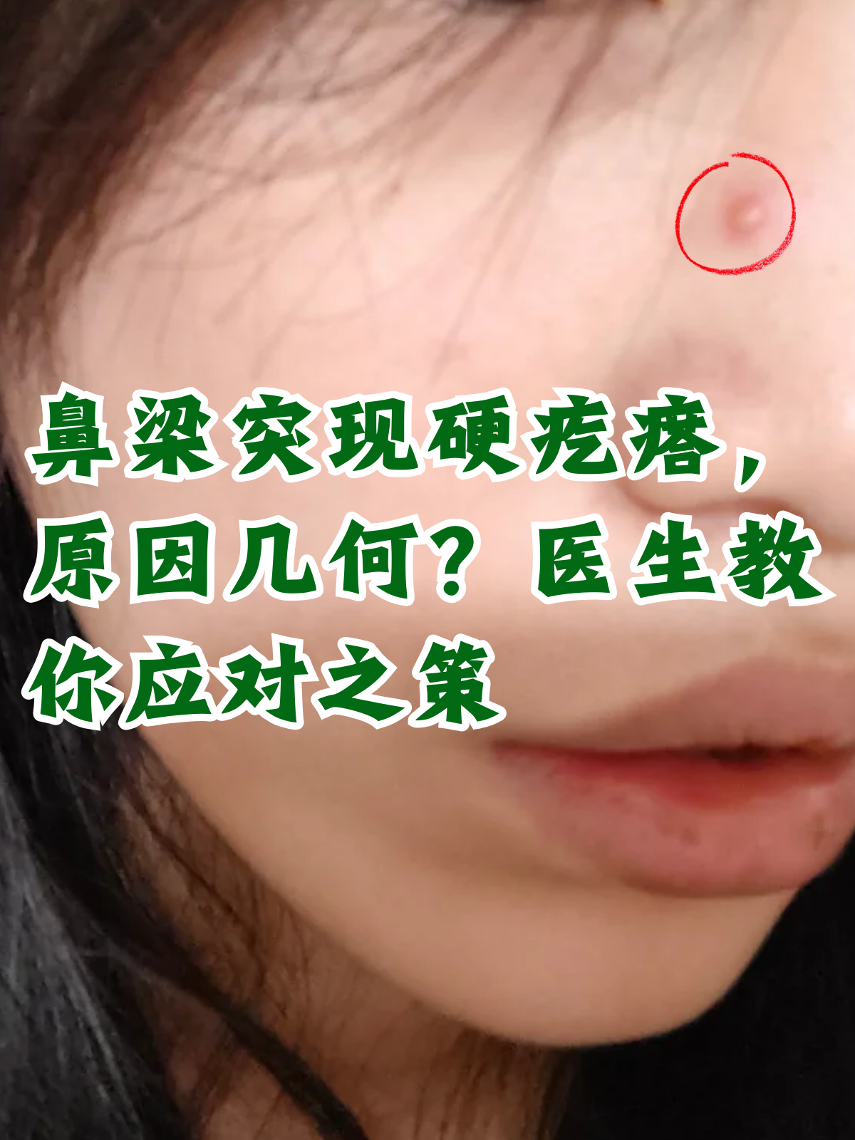 鼻梁子侧面长个凸起硬包有脓水鼻孔的鼻毛入口出现小硬痘原因鼻头长