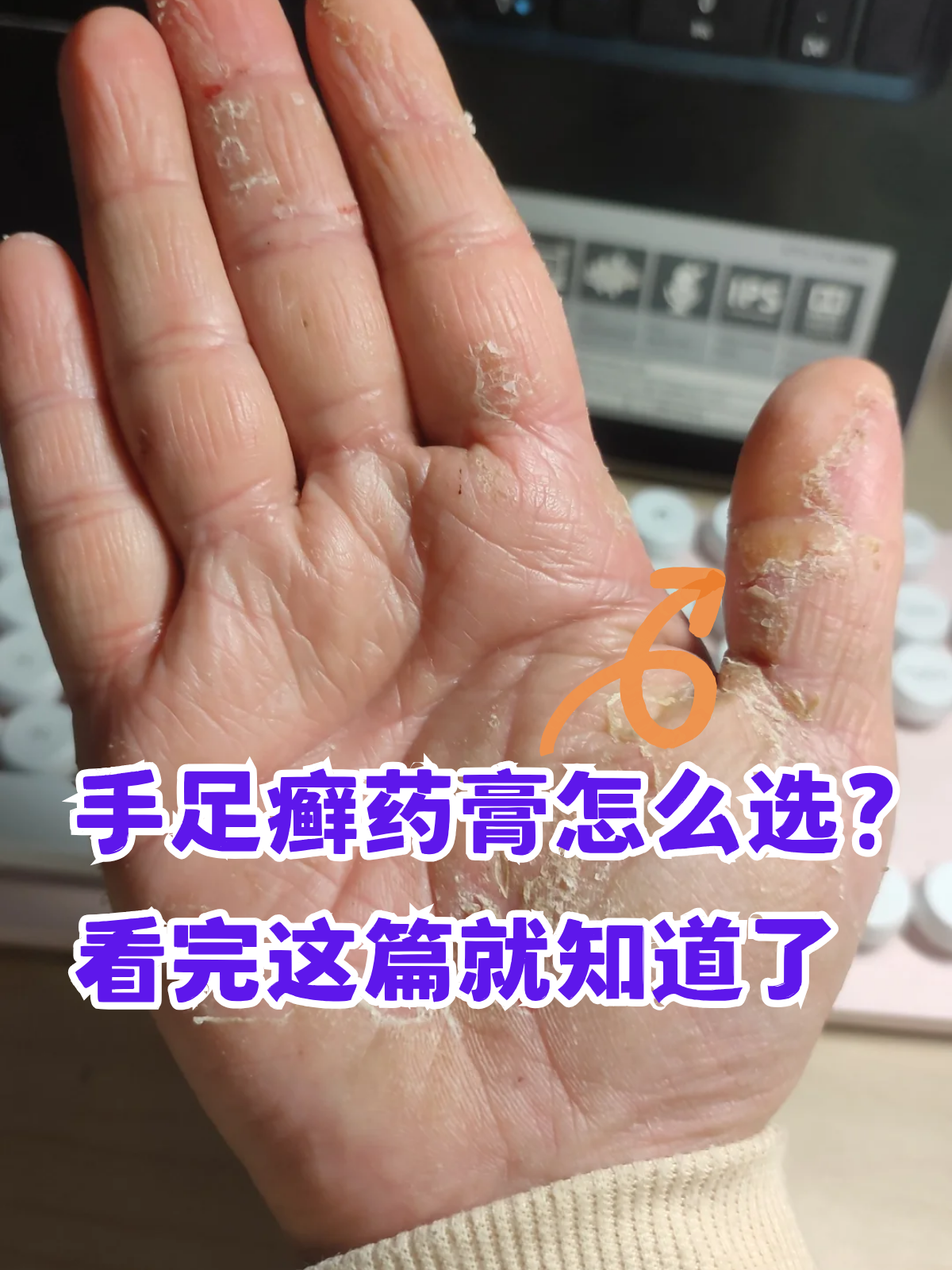 看完这篇就知道了 手足癣作为真菌感染性皮肤病,瘙痒,脱屑,水疱等症状