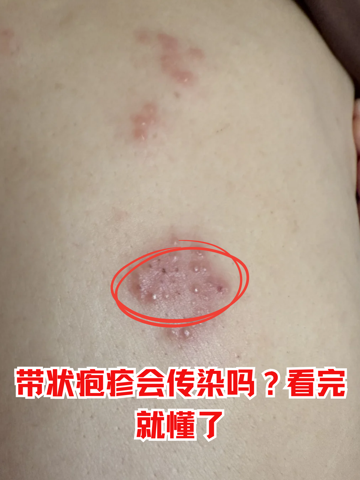 带状疱疹会传染吗?