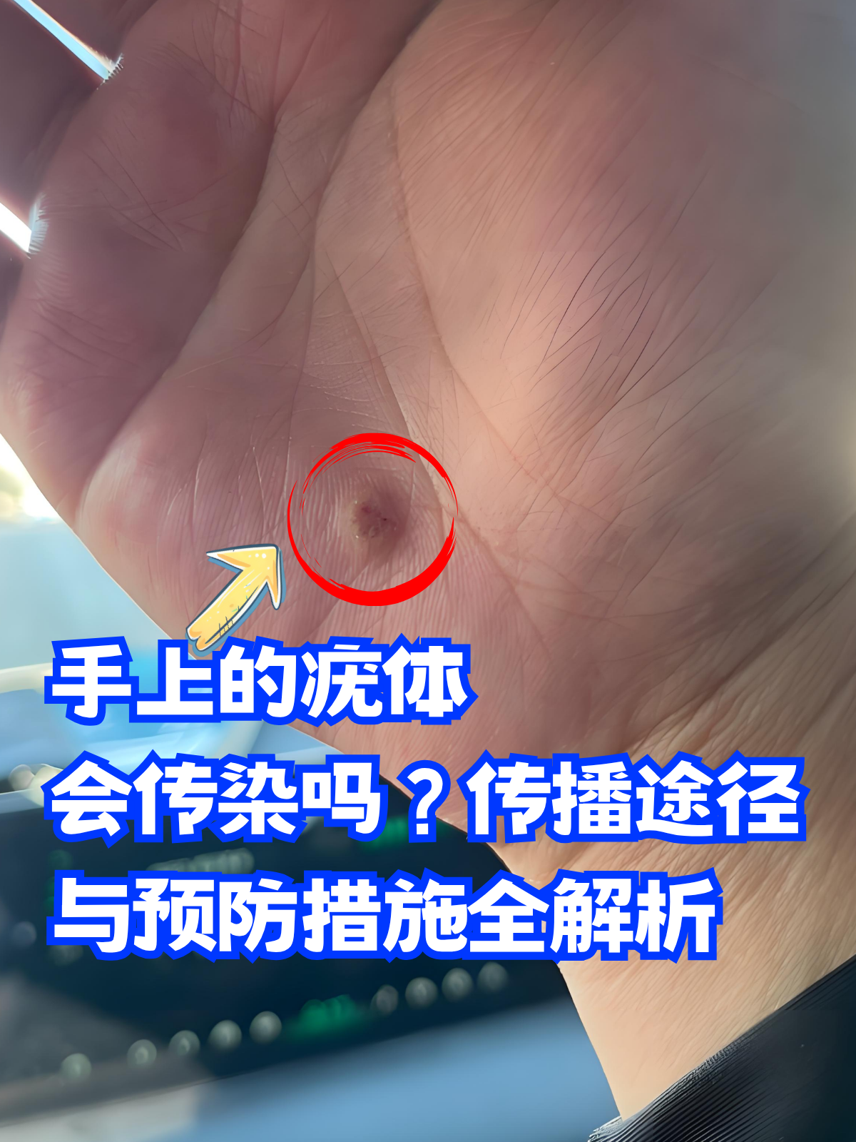 手上的疣体会传染吗?