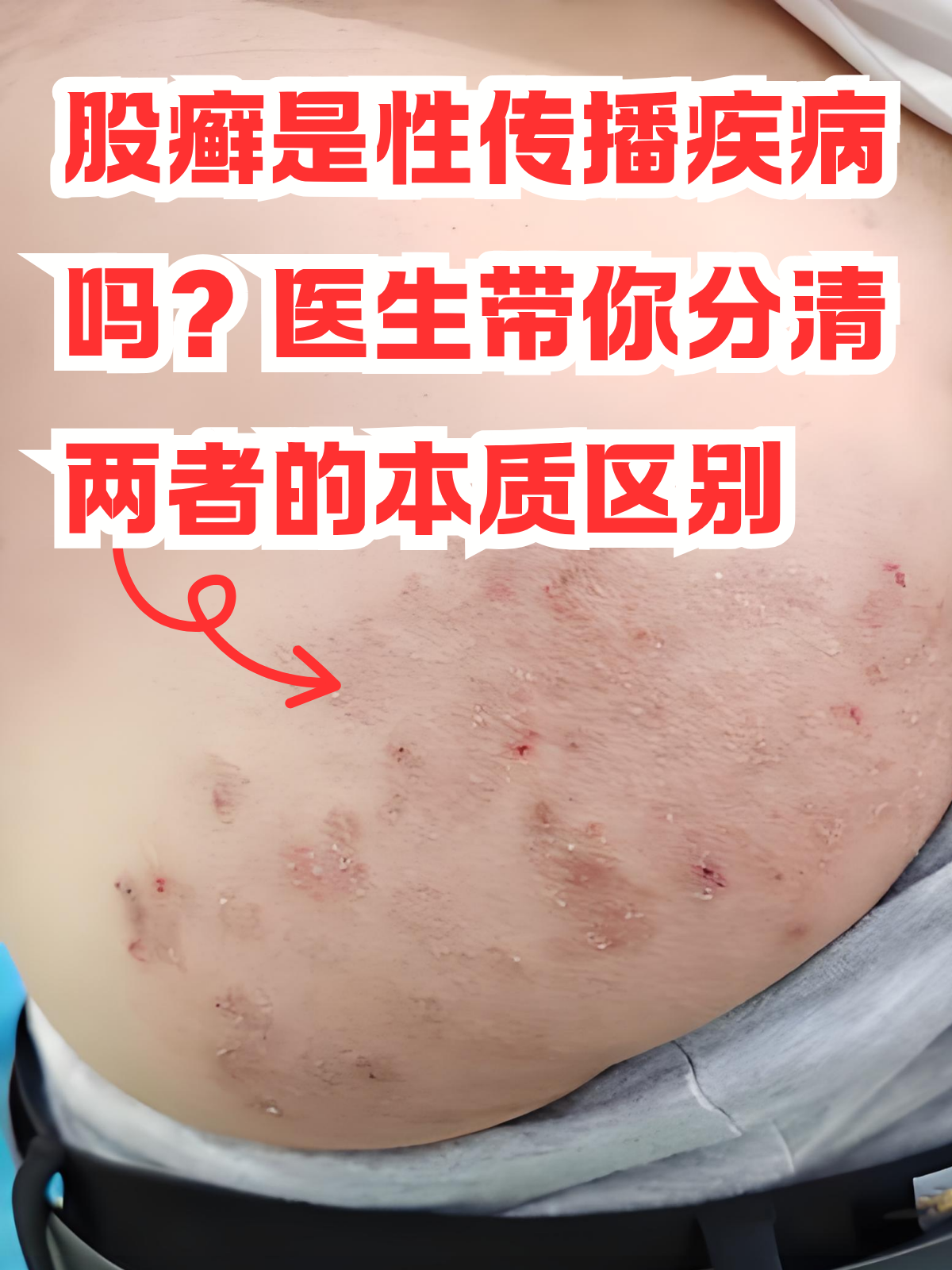 很多人容易产生误解,甚至因此产生心理女性股癣的图片腹股沟股癣什么