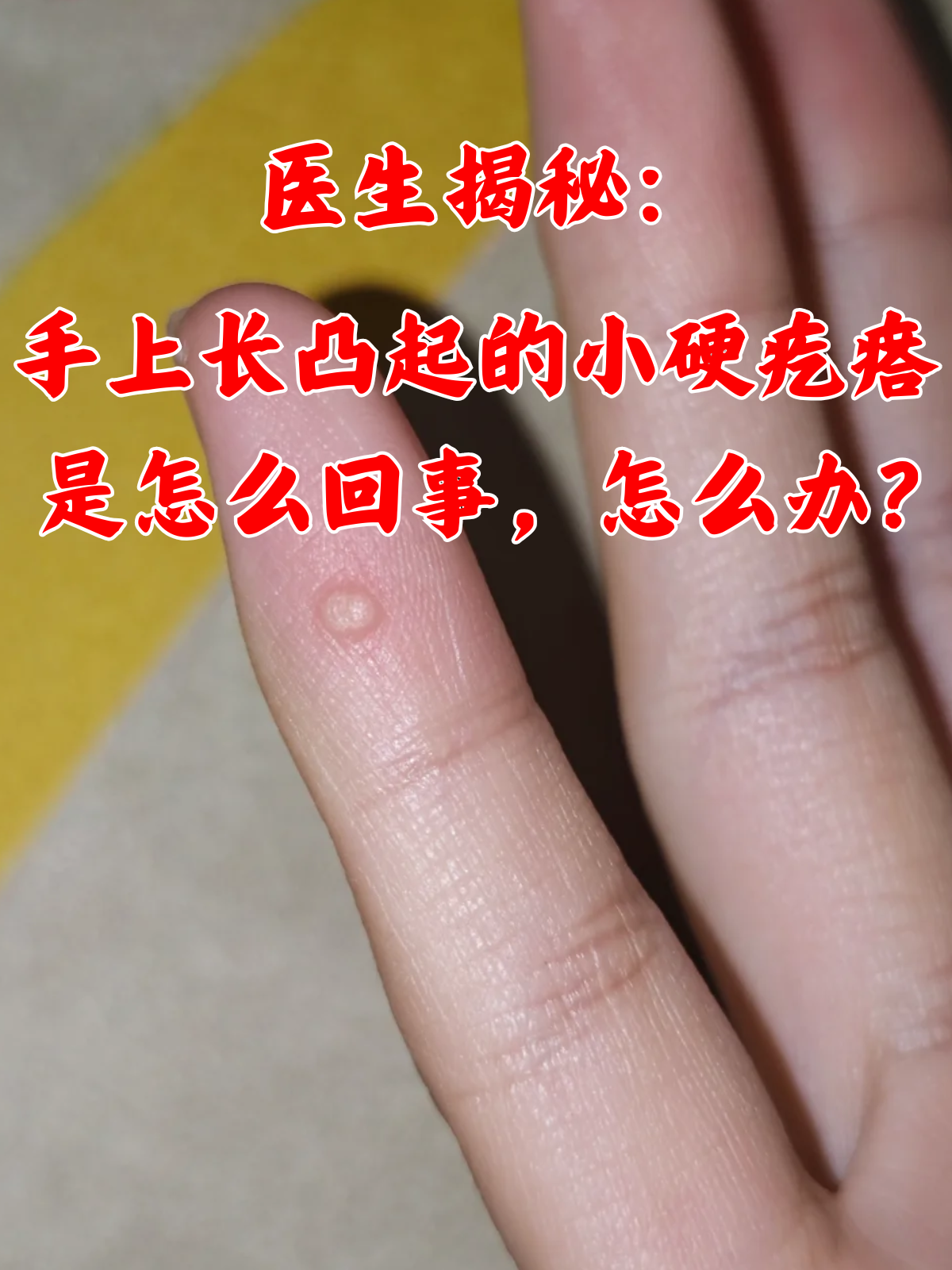 在日常生活中,有些人可能会发现自己的手上突然冒出凸起的小硬疙瘩