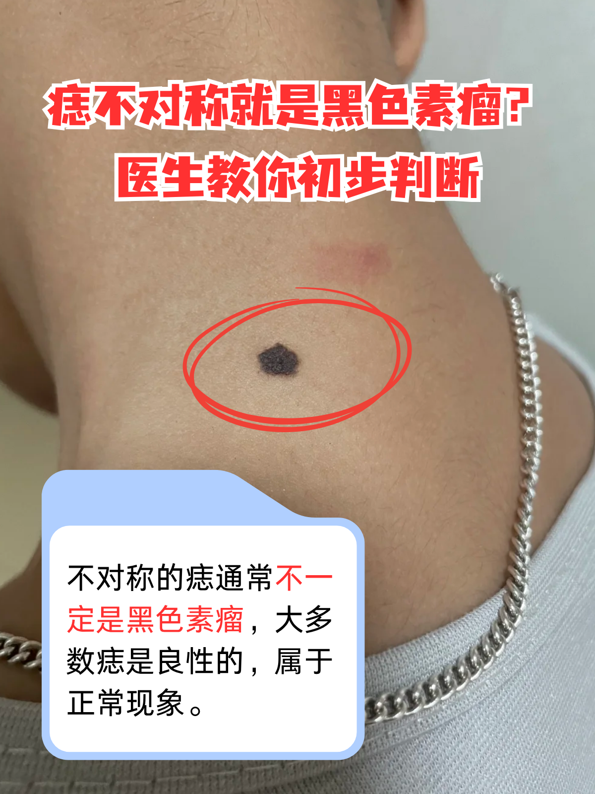 不对称只是黑色素瘤的一个特征,不代表所有不对称的痣都是恶性