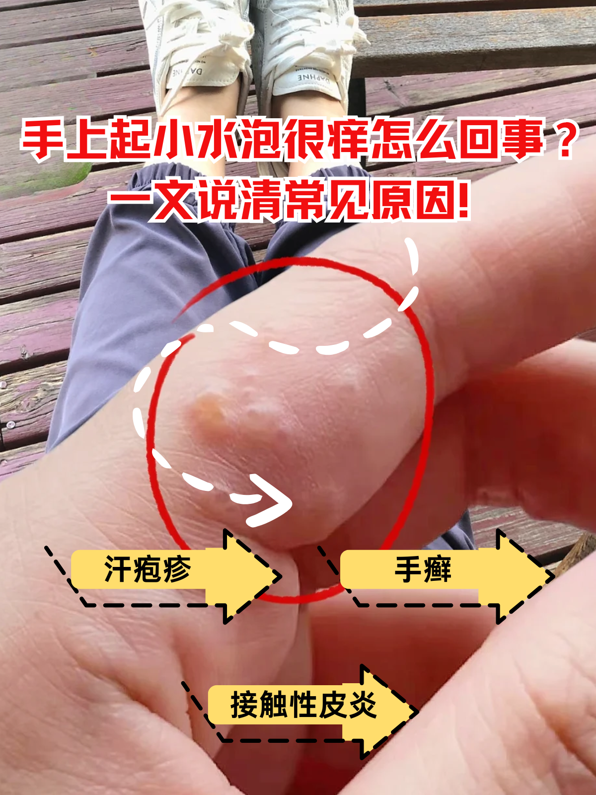 为什么起水泡总是在秋季出现百科在线