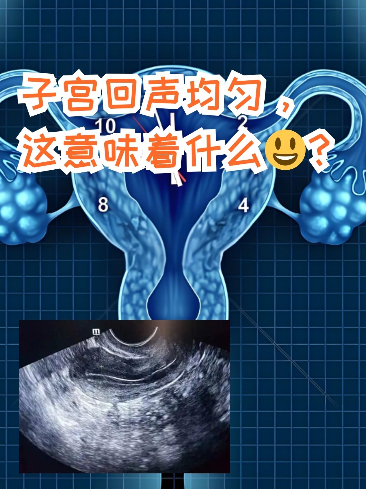当女性朋友们进行b超检查后,看到报告上写着"子宫回声均匀"这几个大