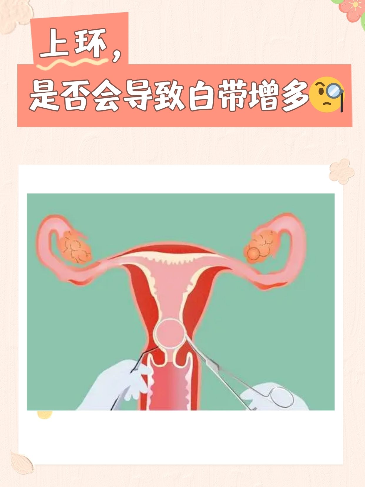 但同时,也会有一些担忧,比如上环会导致白带增多,那这种担忧到底是不