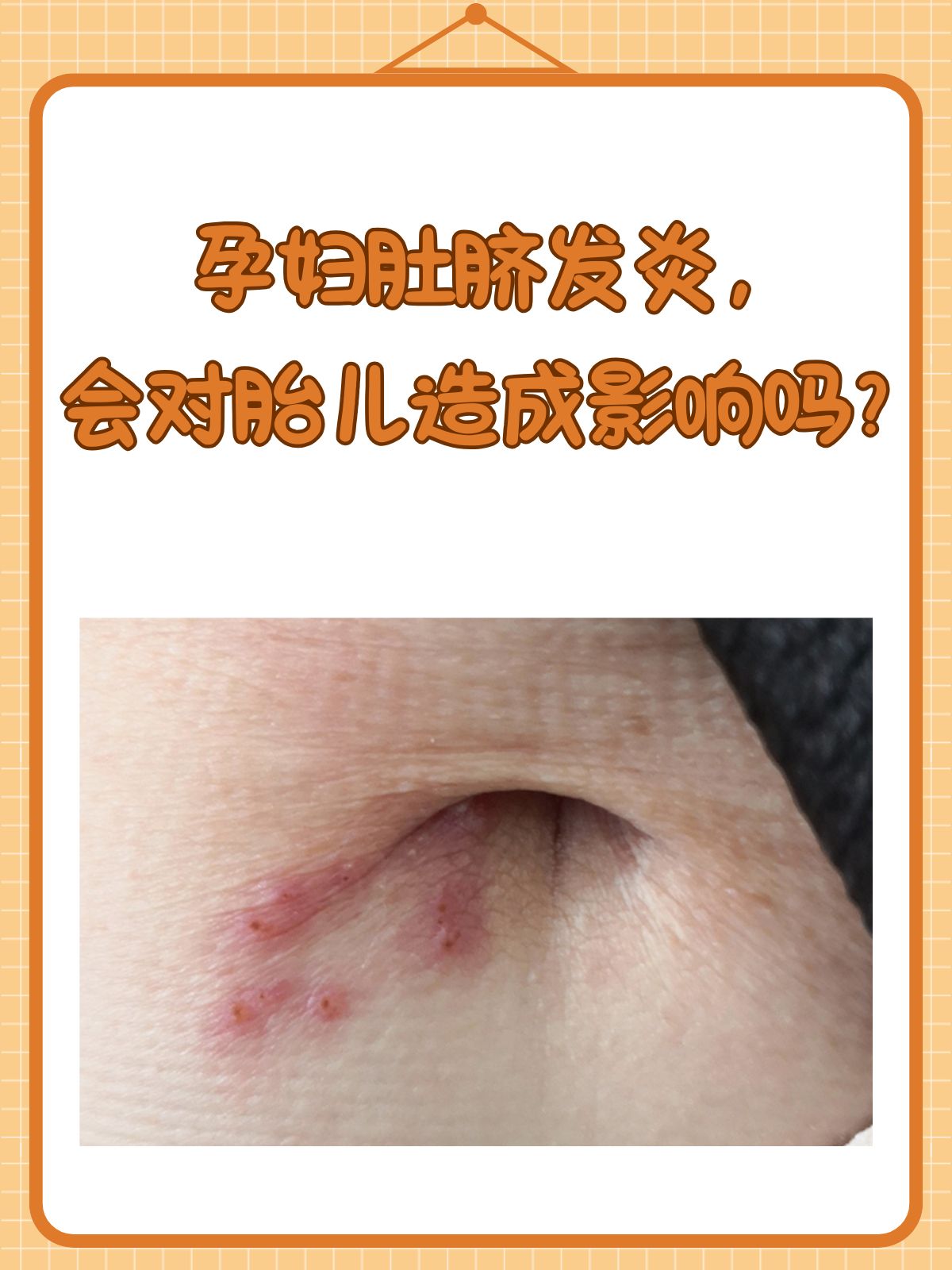 脐炎肚脐眼发红图片孕妇肚脐眼周围起红有脓水且痒肚脐孕妇肚脐发炎