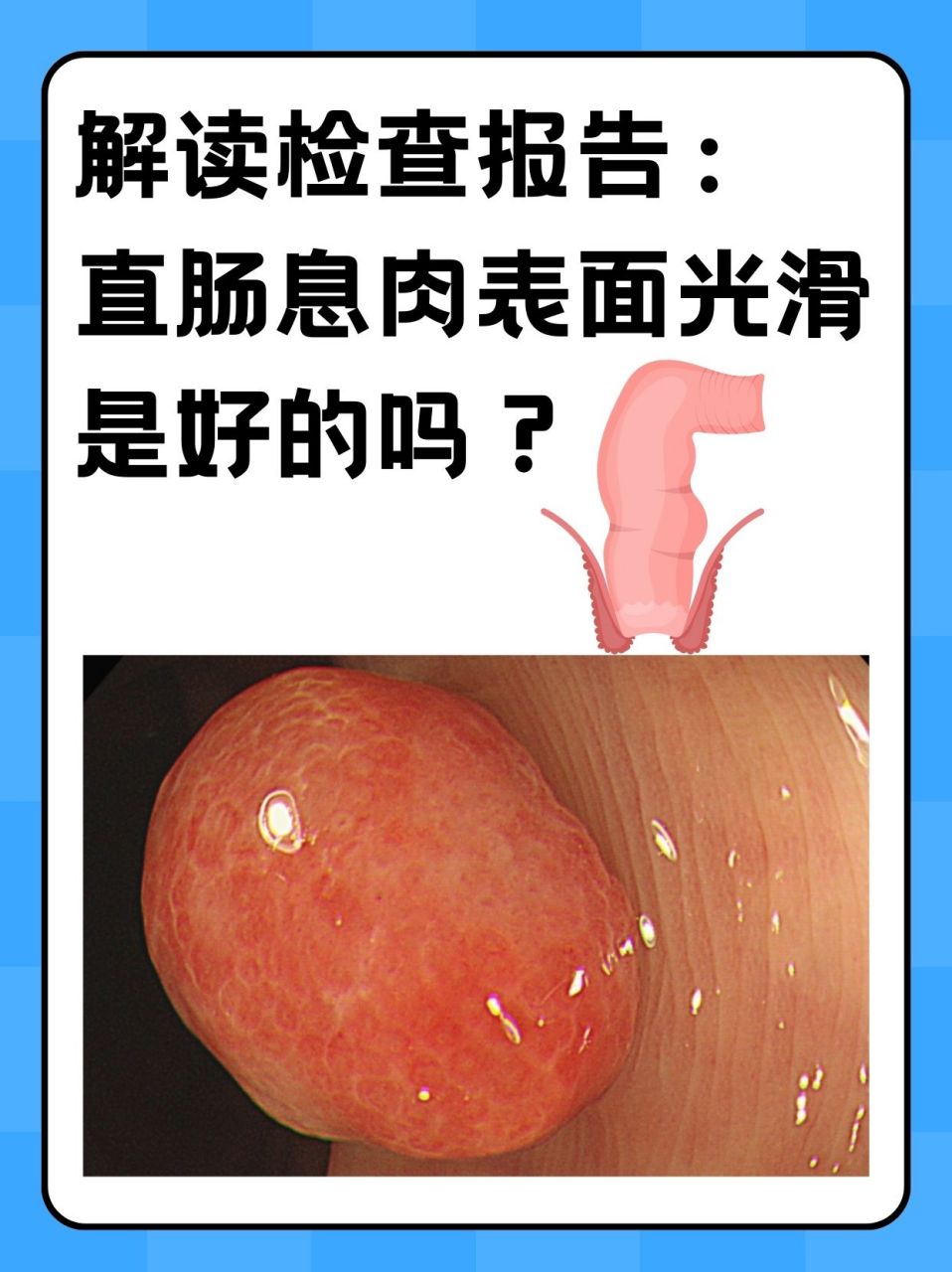 直肠扁平息肉图片