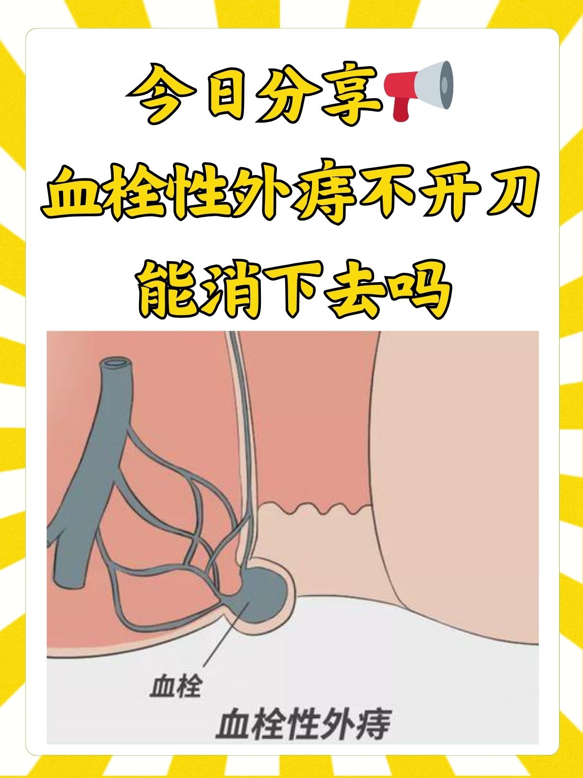 那血栓性外痔不开刀能消下去吗?今天咱们就来聊聊这个问题