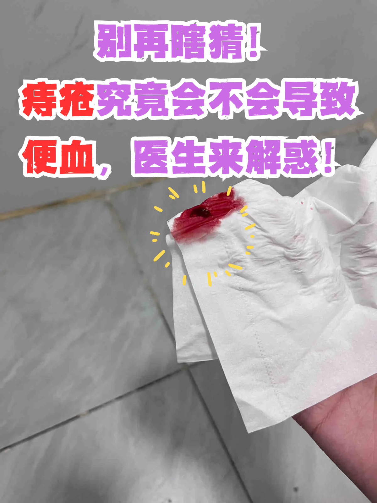 痔疮究竟会不会导致便血,医生来解惑!