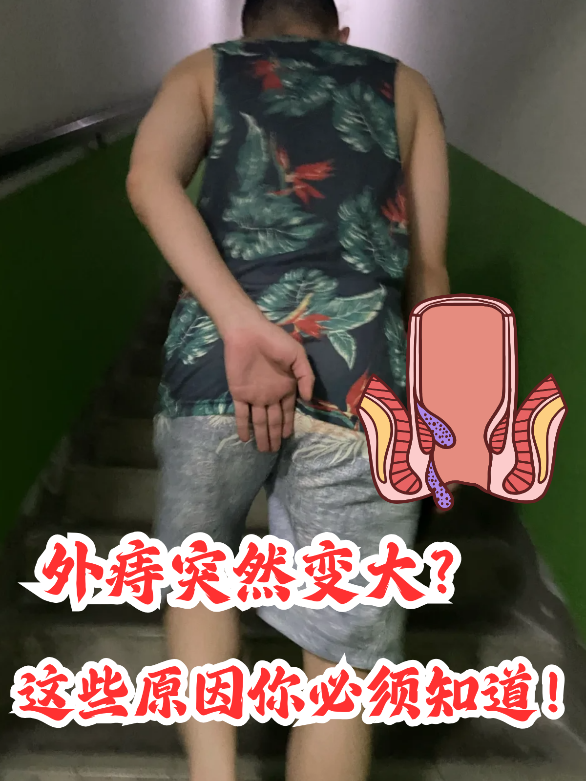 一觉醒来,原本还能"和平共处"的外痔突然肿成了"小肉球",疼痛,坠胀感