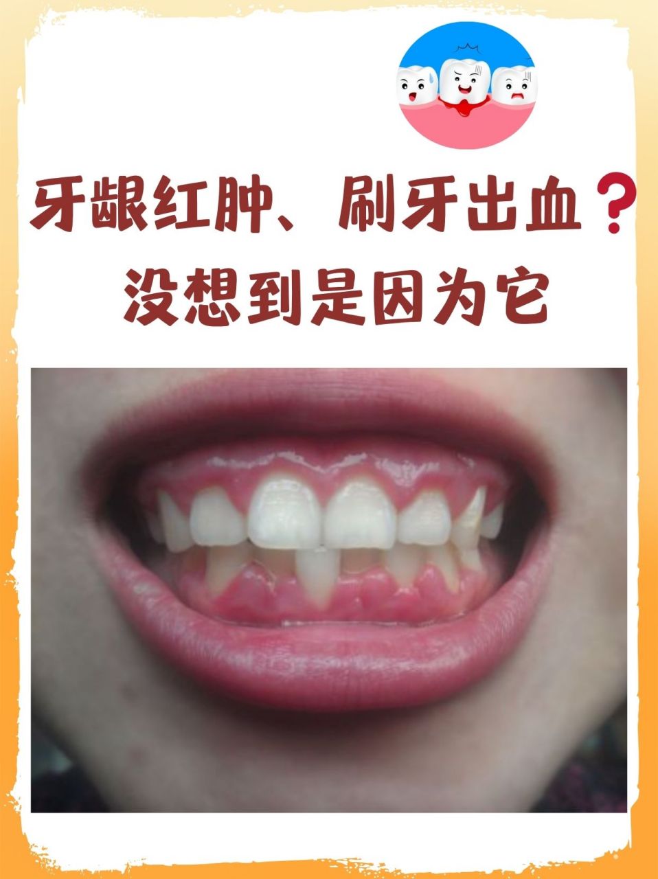 牙龈红肿,刷牙出血❓没想到是因为它 牙龈这位守卫者偶尔也会闹点"
