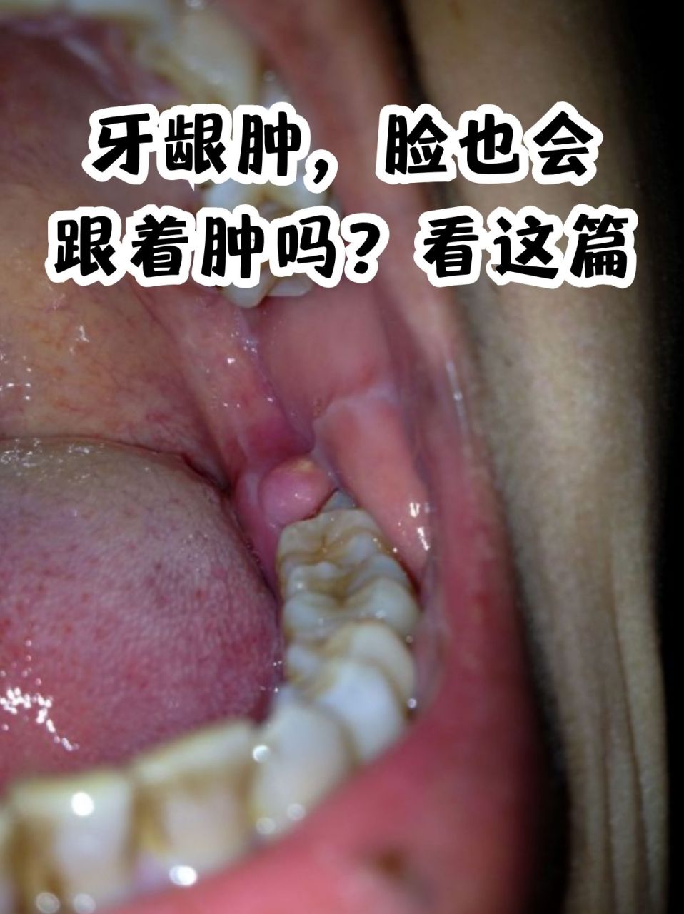 周围,为细菌提供大量能量来源,导致很多口腔问题的产生,如牙龈肿痛