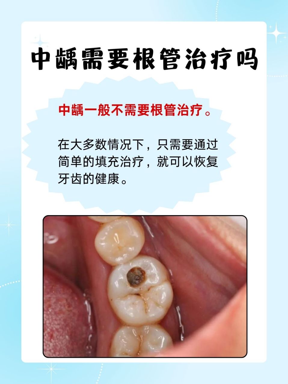 龋齿(蛀牙)是我们常遇到的"小麻烦"之一.