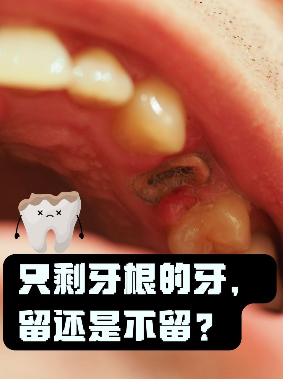 牙根腐烂怎么办图片