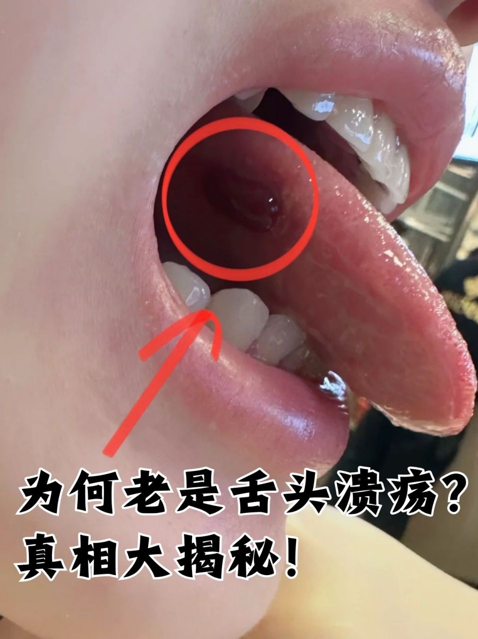 真相大揭秘! 在日常生活中,舌头溃疡是一种让人颇为苦恼的问题.