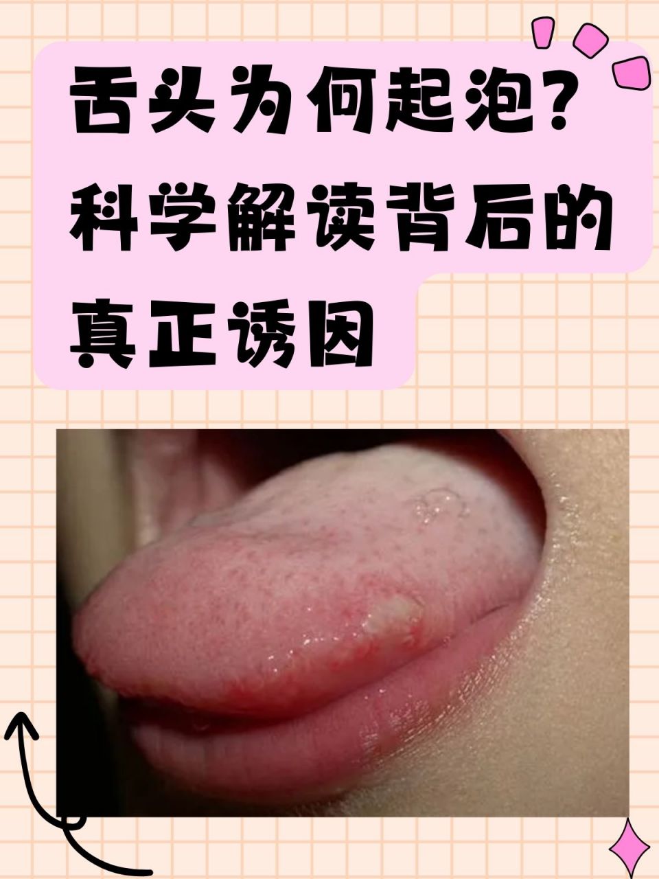 科学解读背后的真正诱因 舌头起泡这一现象令人十分困扰,不仅影响食欲