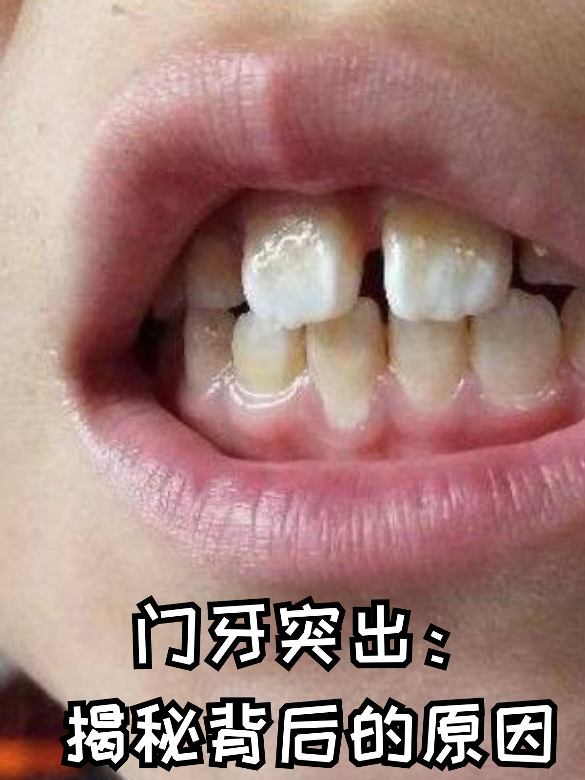 那么,究竟是什么导致了门牙突出呢?让我们一起探索其中的奥秘