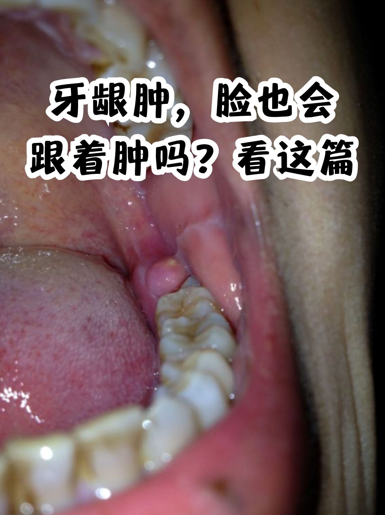 食物残渣更容易残留在牙齿周围,为细菌提供大量能量来源,导致很多口腔