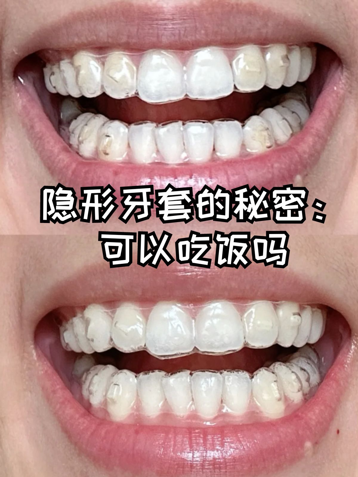 戴上隐形牙套后,可以正常吃饭吗?一般是不可以的