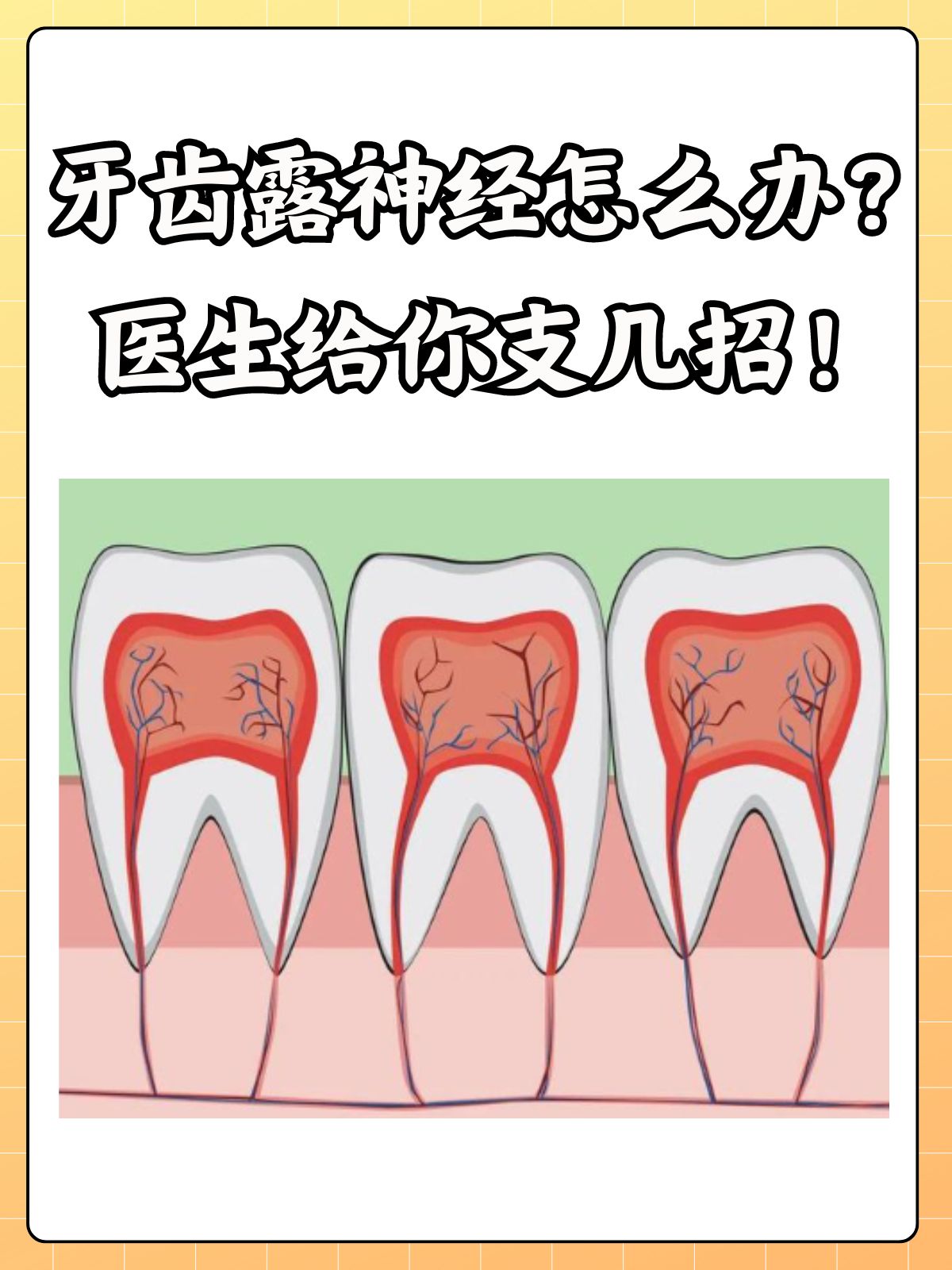 牙齿露神经怎么办?医生给你支几招!