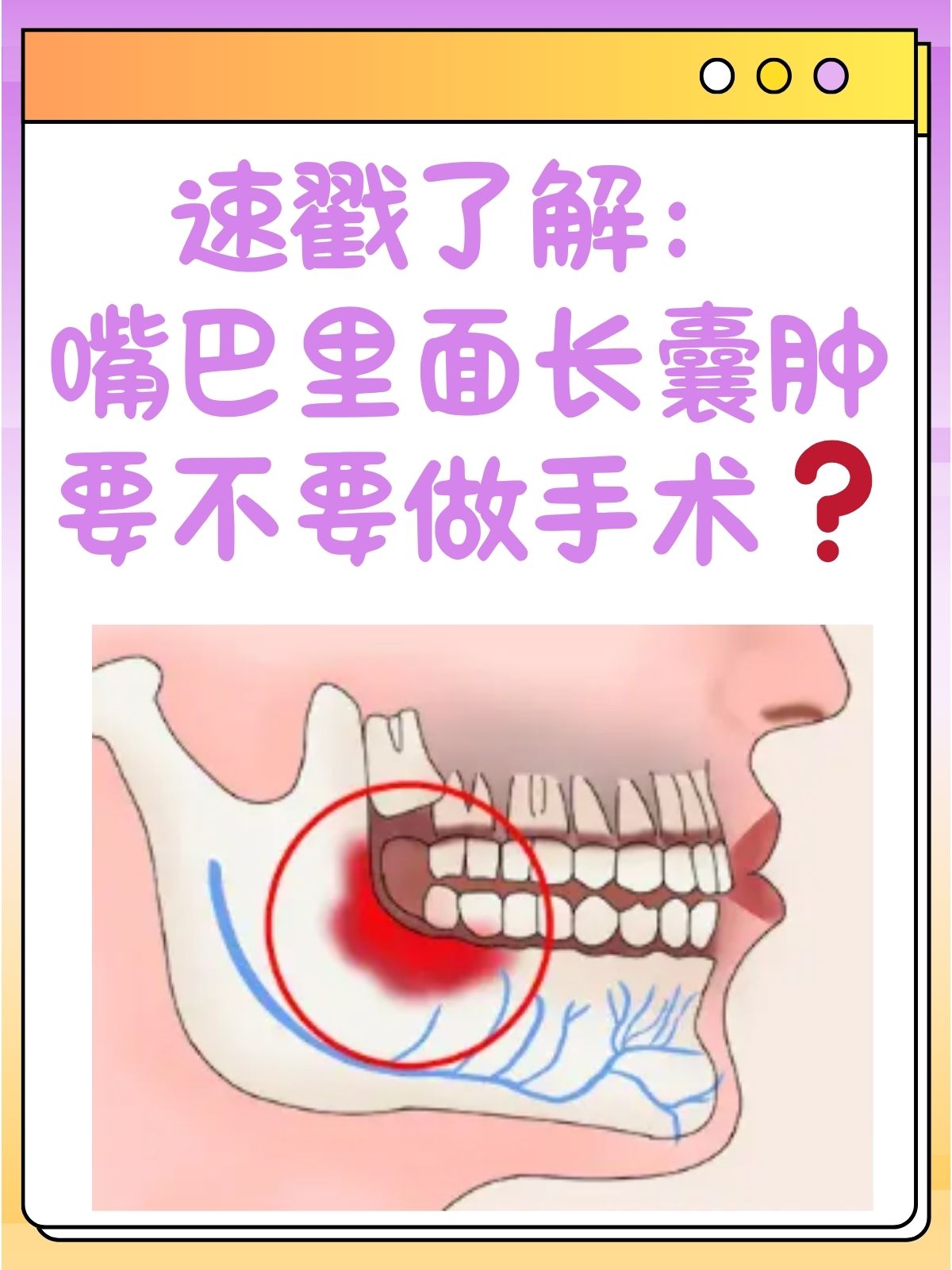 软腭囊肿图片