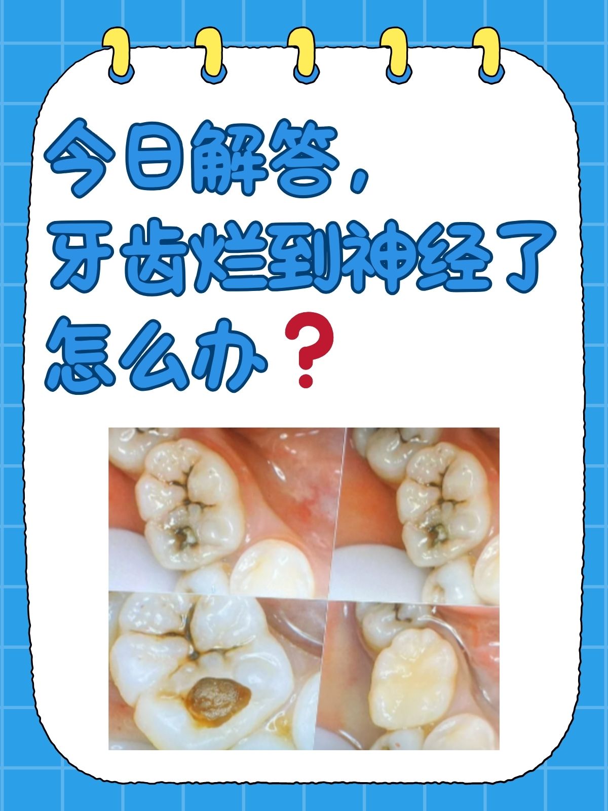 杀了神经的牙为什么还疼