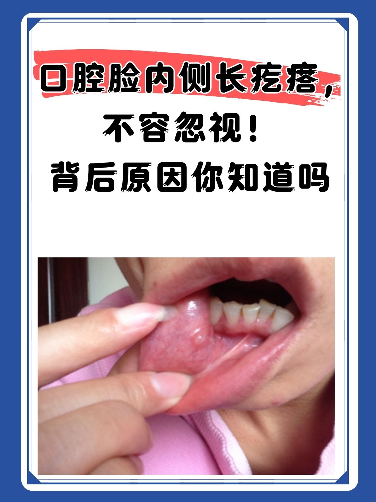 通常口腔脸内侧长疙瘩的原因是比较多的,而常