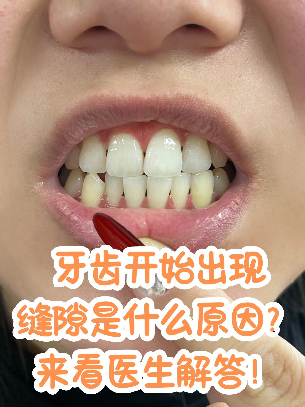 牙齿的排列与咬合不仅关乎美观,更直接影响到咀嚼功能,发音清晰度