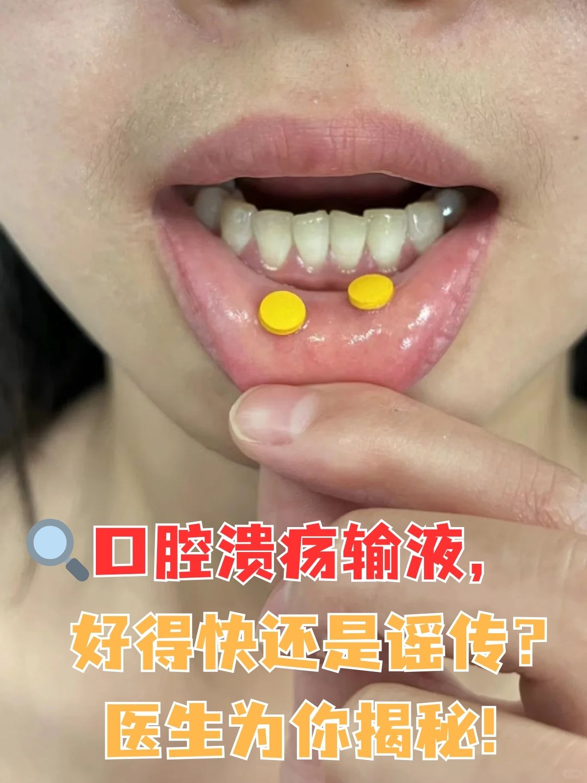 嘴巴里突然冒出个"小火山",疼得连喝水都像在受刑,口腔溃疡可真是磨