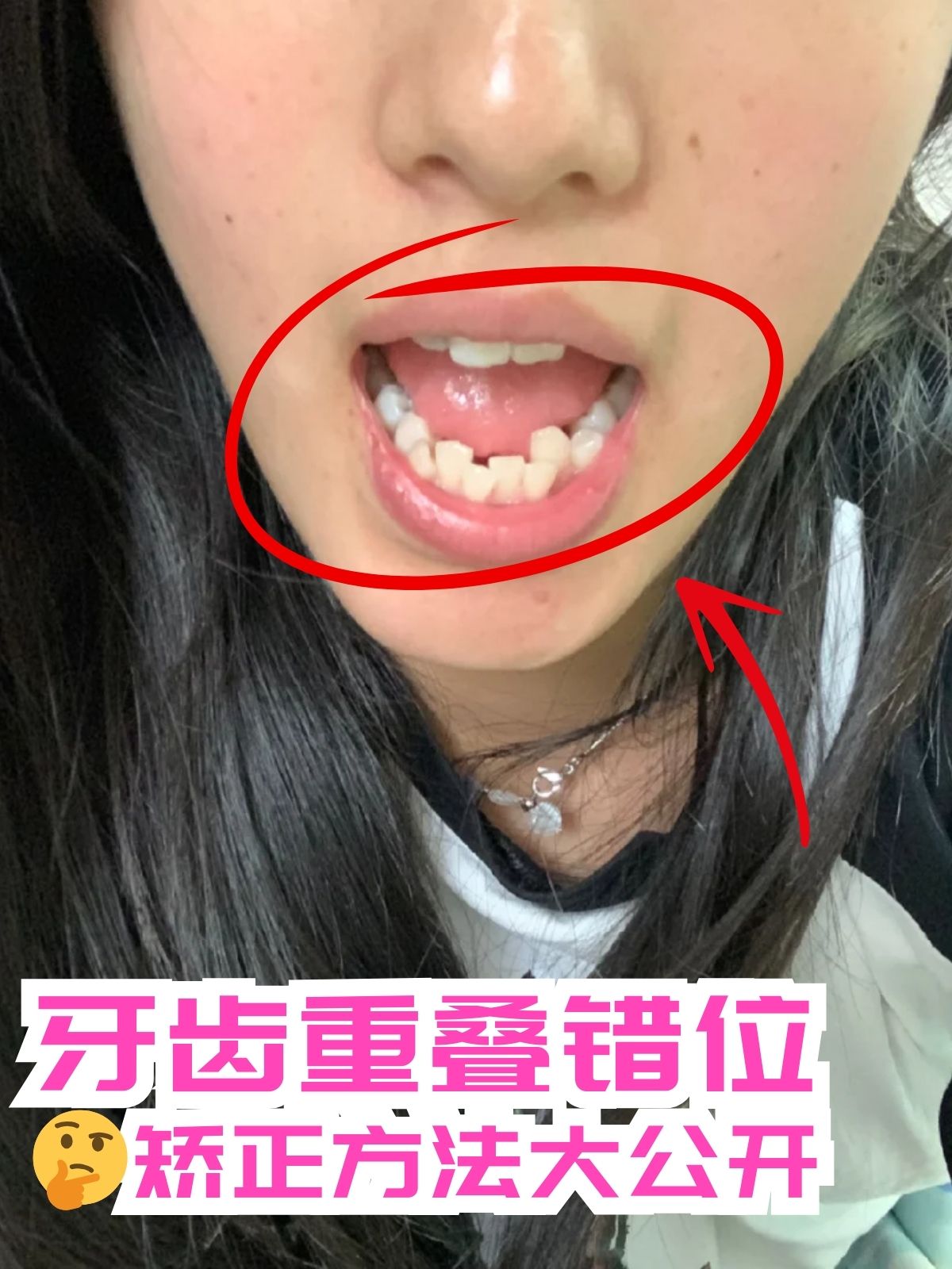 重叠牙齿图片下排牙齿向内倾斜叠牙上下颚骨咬合错位图片牙齿长歪了