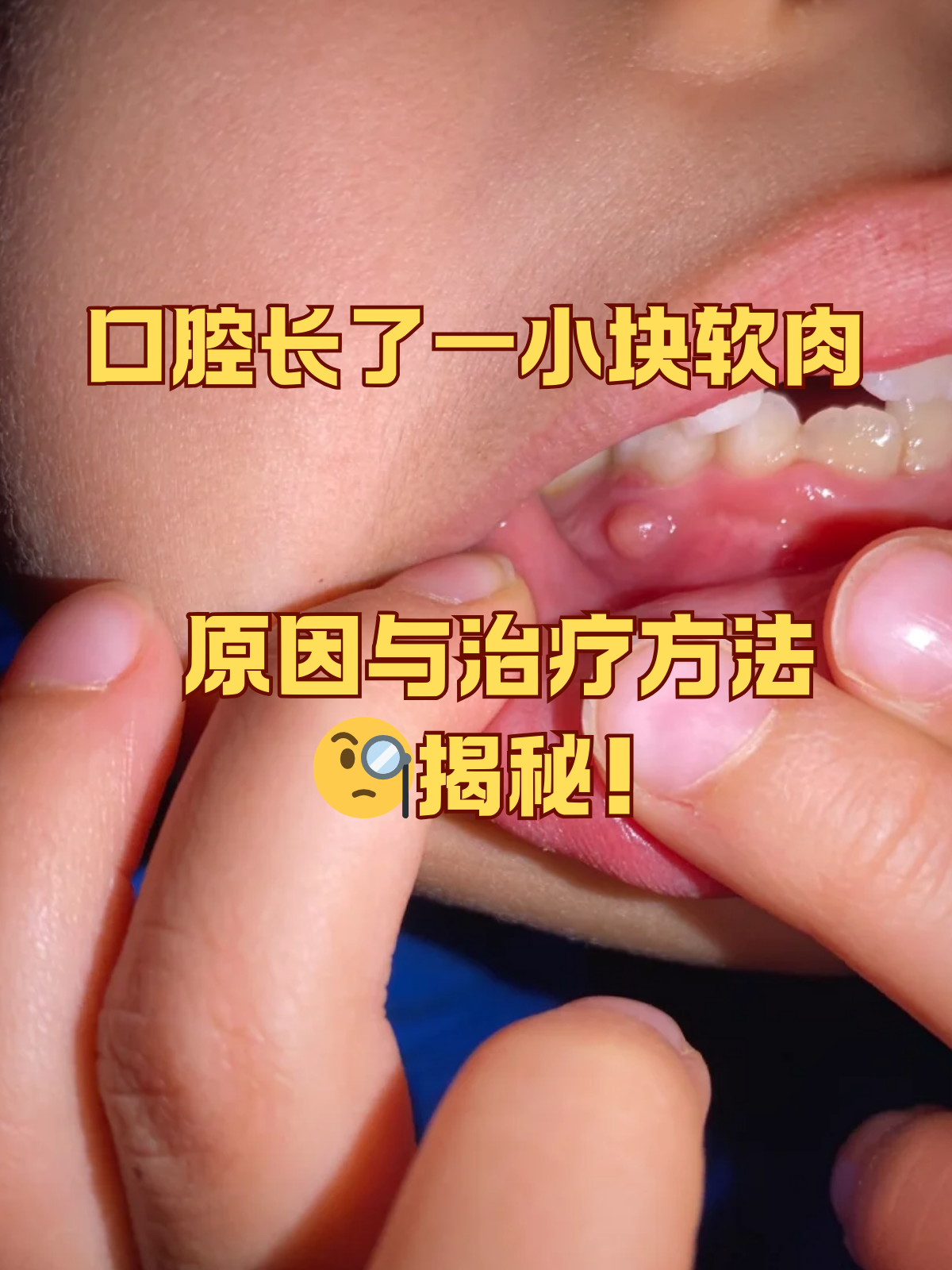口腔长了一小块软肉,原因与治疗方法揭秘!