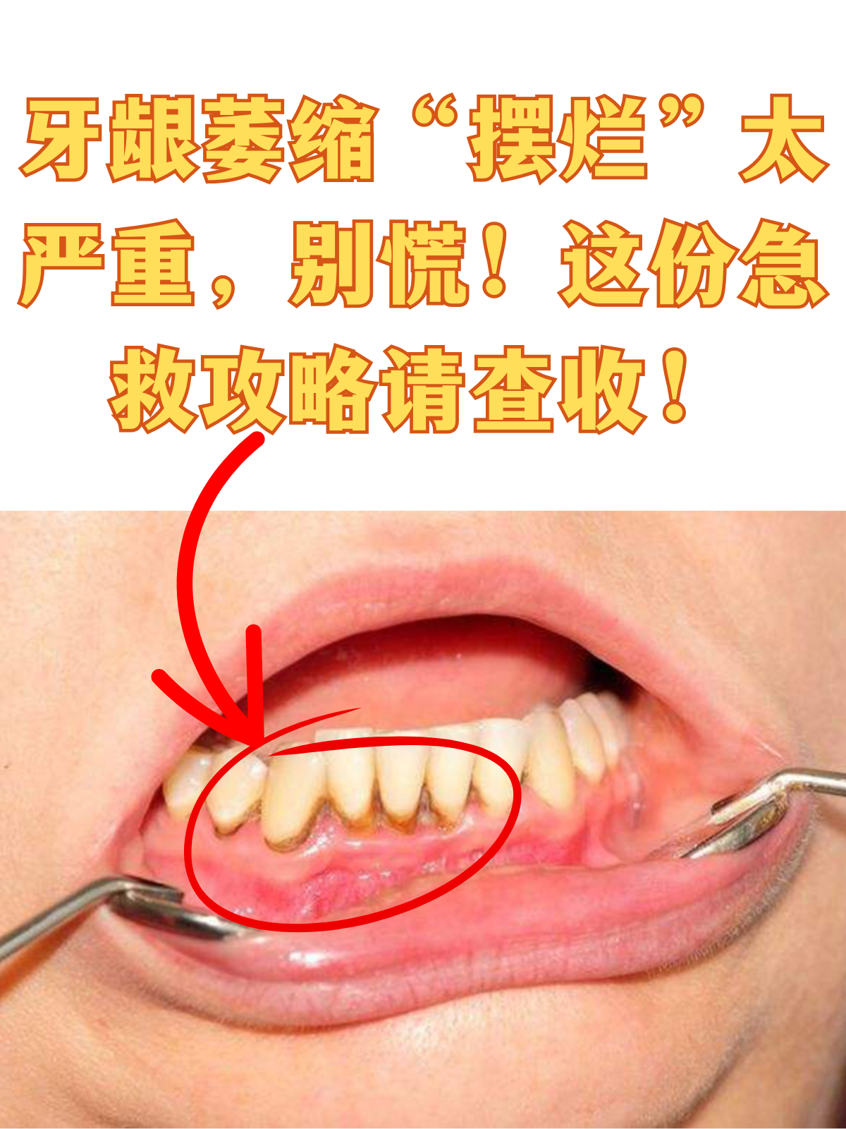 牙龈萎缩"摆烂"太严重,别慌!这份急救攻略请查收!