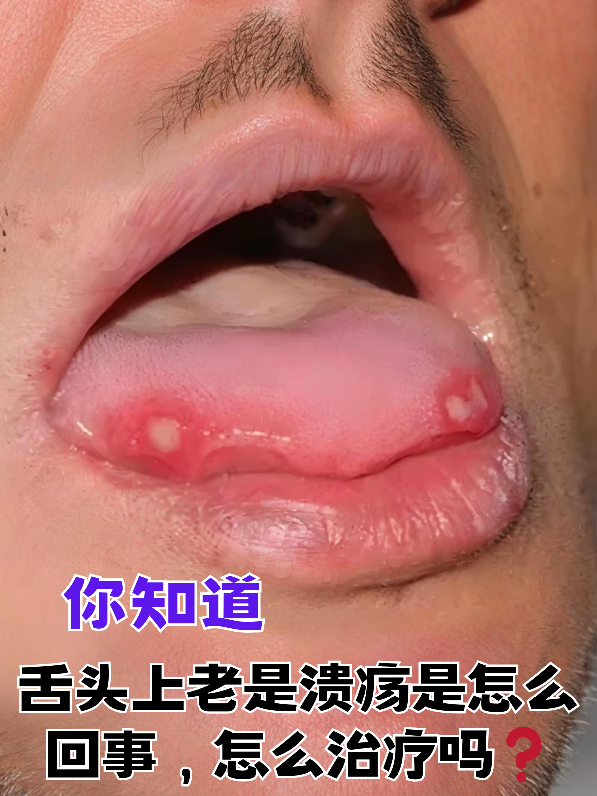 你知道,舌头上老是溃疡是怎么回事,怎么治疗吗 舌头上长溃疡是一个让